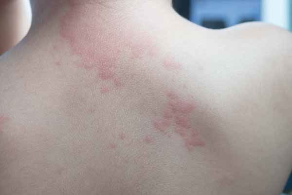 orticaria tipologie sintomi e cure