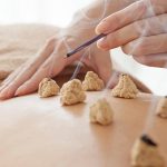 Moxibustione: il calore dell’artemisia nella medicina tradizionale cinese.