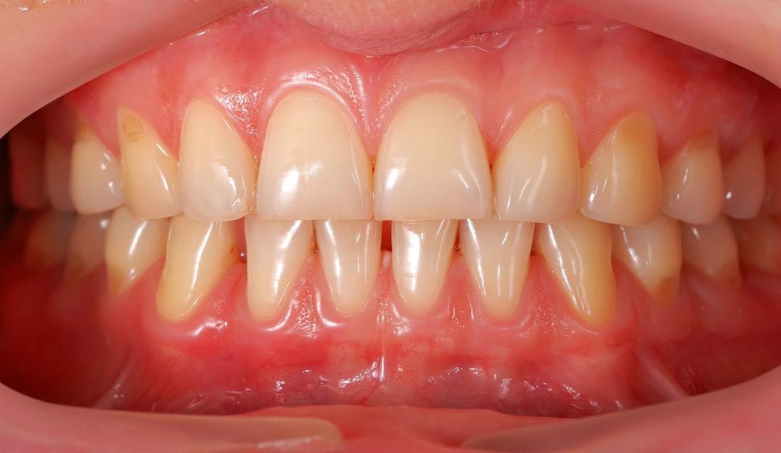 Oil pulling: il risciacquo ayurvedico per la salute di bocca e gengive.