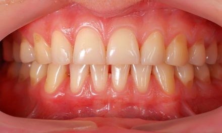 Oil pulling: il risciacquo ayurvedico per la salute di bocca e gengive.