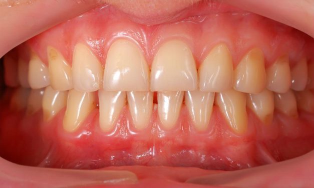 Oil pulling: il risciacquo ayurvedico per la salute di bocca e gengive.